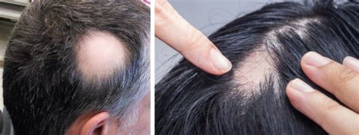 Do bald spots grow back?
