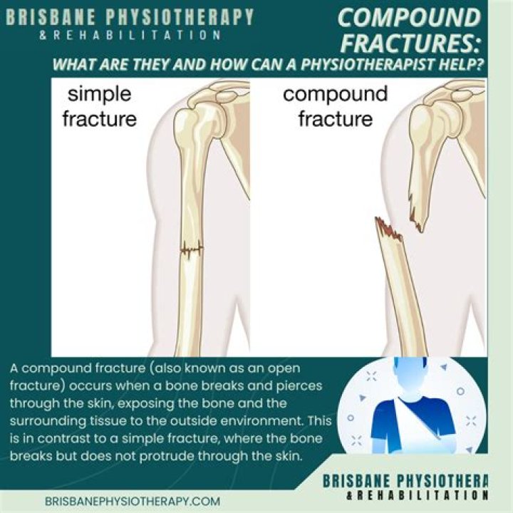 How long do you stay in the hospital for a compound fracture?