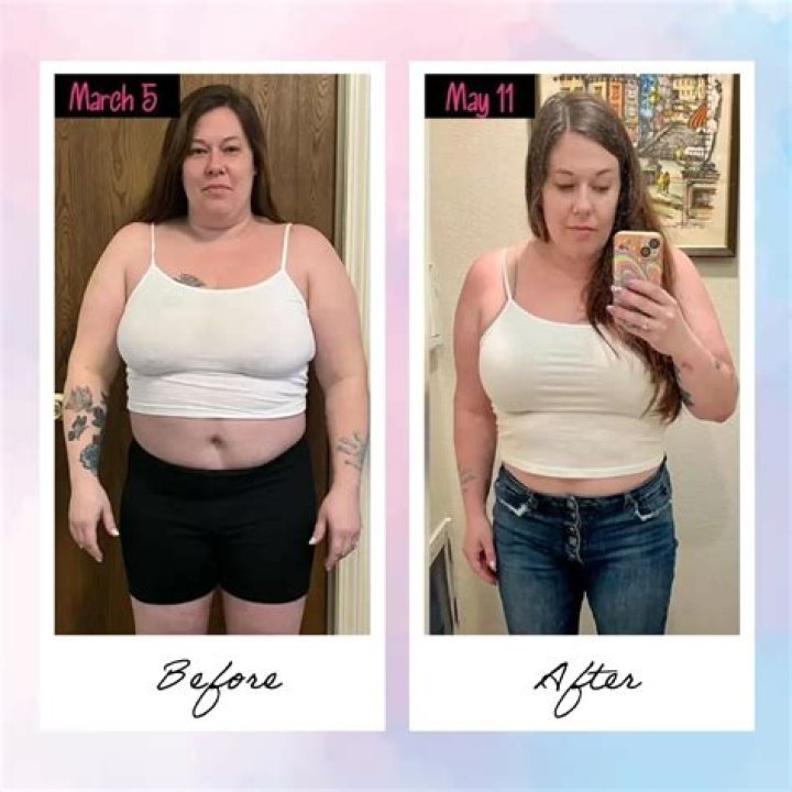 Is it better to lose weight before or after liposuction?