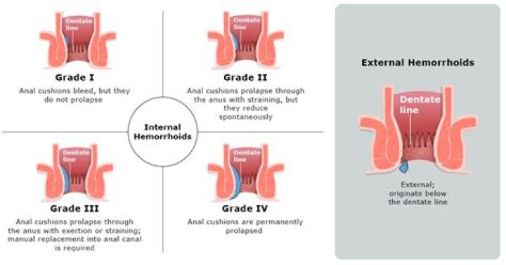 What Colour are external hemorrhoids?