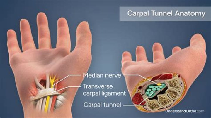 Who is most likely to get carpal tunnel syndrome?